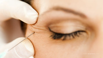 Tratamiento Plasma Rico en Plaquetas