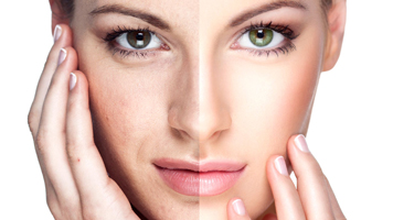 Rejuvenecimiento Facial